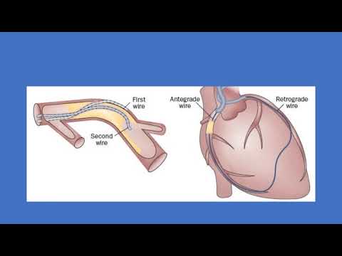 Retrograde RCA intervention with reverse CART