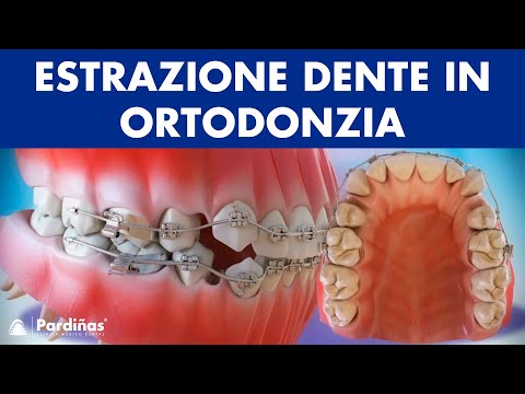 Estrazione dente in ortodonzia ©