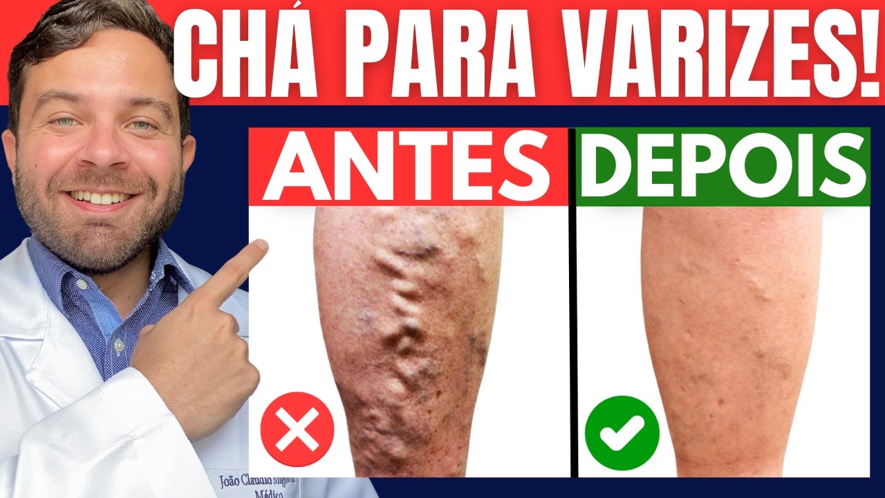 Sinais de MÁ CIRCULAÇÃO e o MELHOR CHÁ para REDUZIR VARIZES