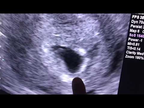 Sonogram: 6 weeks pregnant !