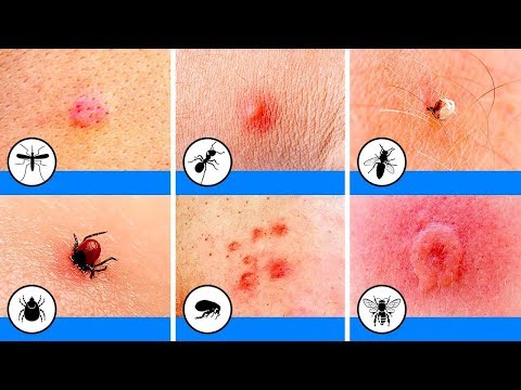 10 Insektenstiche, die jeder identifizieren können sollte