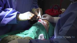 Open Rhinoplasty Procedure Breakdown