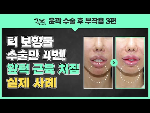 윤곽수술 부작용 및 대처법, 얼굴 처짐 해결 사례!