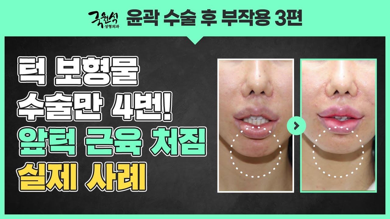 윤곽수술 부작용 및 대처법, 얼굴 처짐 해결 사례! 썸네일
