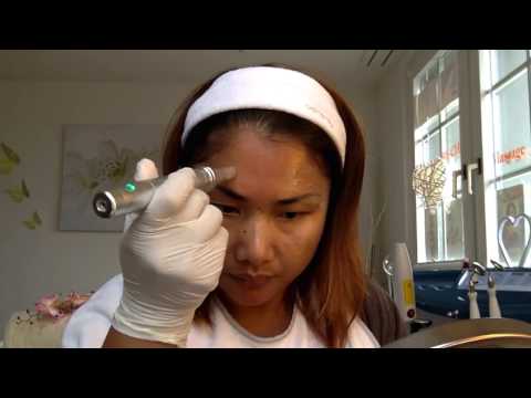 Faltenbehandlung mit WandaPen & EGF HA Solution für Schönes Gesicht