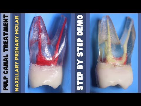 Pediatric Root Canal Treatment -  Maxillary Primary Molar - Step by Step