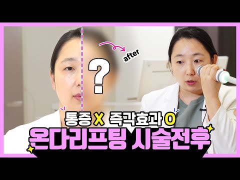 オンダリフト施術前後 / 痛みのないオンダリフトの効果を確認してみよう !!