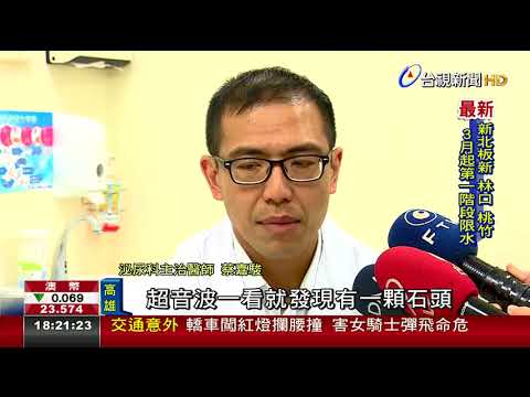 7旬翁小便難解 就醫驚見結石如雞蛋大