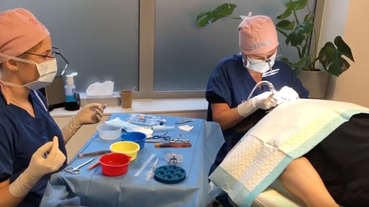 No shave hair transplant - Extraction of the hairs