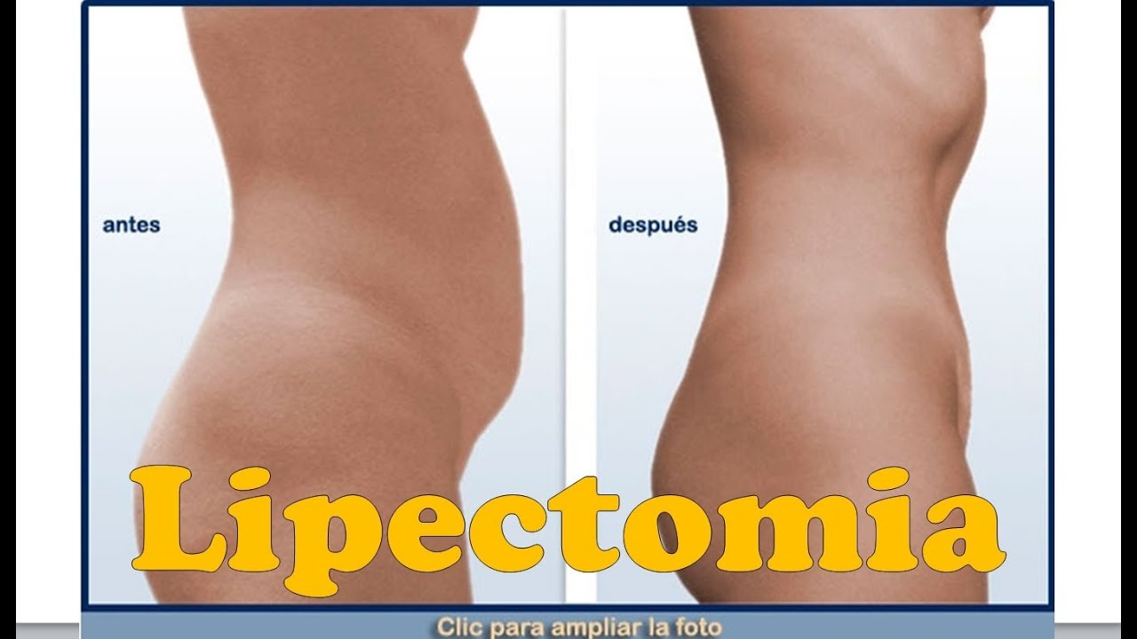 Lipectomia para Exceso de Piel en el Abdomen | Abdominoplastia con Fotos Antes y Despues