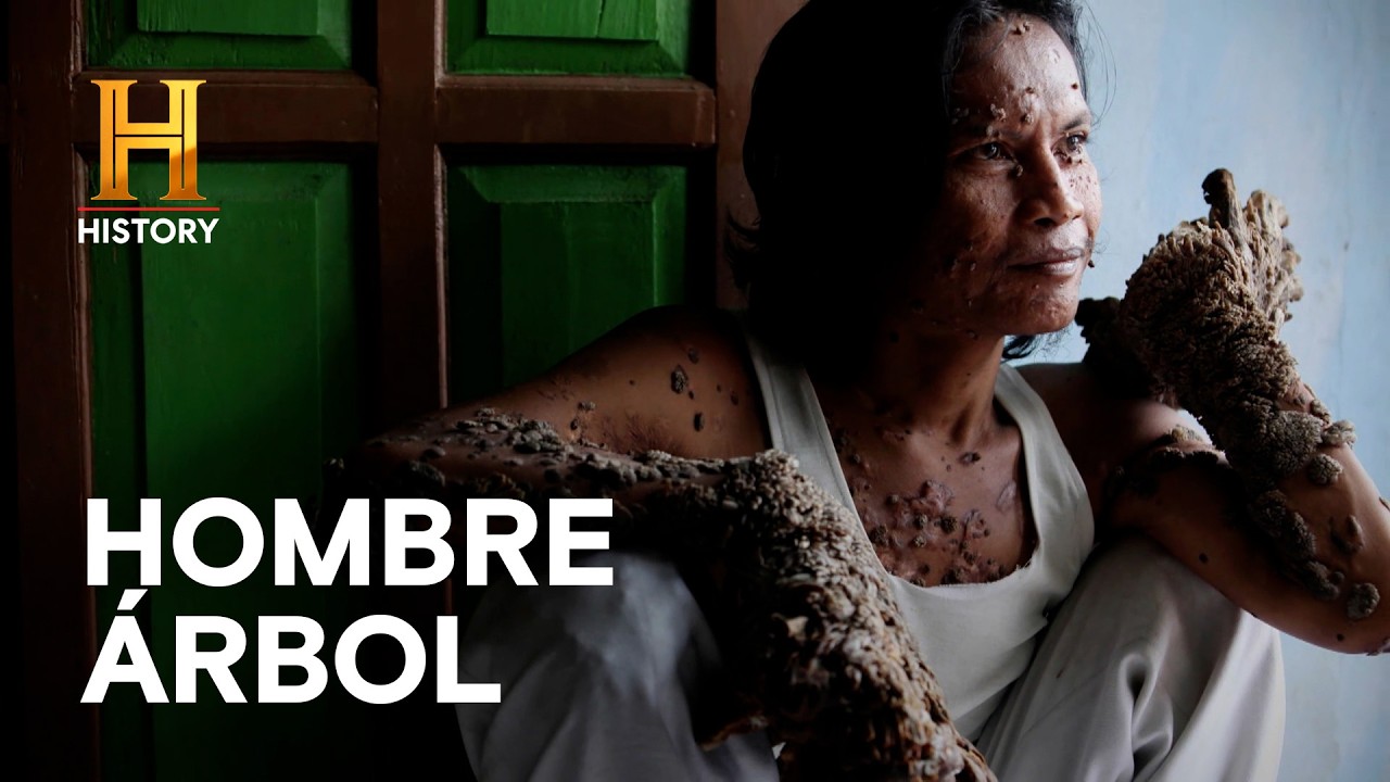 LA EXTRAÑA MUTACIÓN DEL HOMBRE ÁRBOL 🌳 - La evidencia está entre nosotros