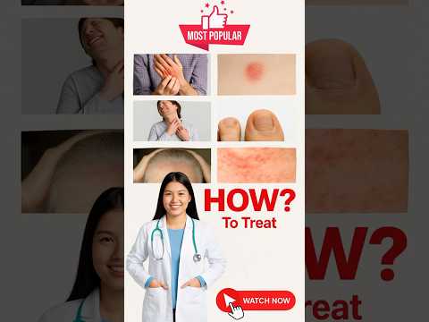 Rudramani Ringworm Treatment Itch-cort  Ointment skin Fungal Ointment -25gm