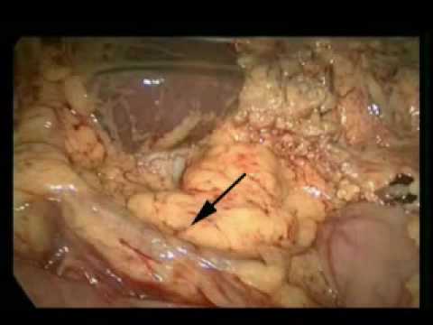 Laparoscopic Distal Stomach Excision And D1 Lymph Nodes Removal Due To Adenocarcinoma