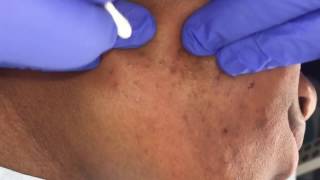 Blackhead Breakout