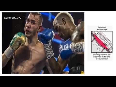 BOXER MAXIM DADASHEV - BRAIN INJURY--INCREASED INTRACRANIAL PRESSURE