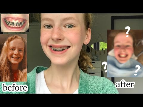 YESSS, mijn beugel gaat eruit! #vlog