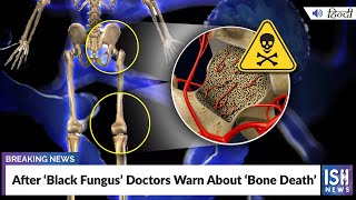 After ‘Black Fungus’ Doctors Warn About ‘Bone Death’