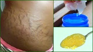 GET RID OF STRETCH MARKS, FAST ACTING EFFECTIVE HOME REMEDY, Khichi Beauty