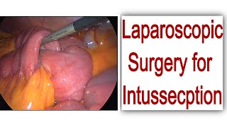 Surgery : LAP Intussusception reduction