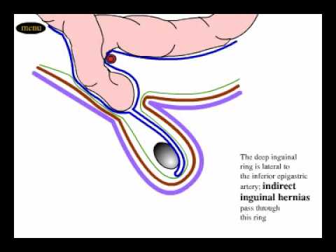 Inguinalis herni prosztatagyulladás, Prosztatagyulladás és adenómák póréhagyma kezelése