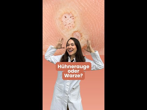 Is this a wart or a corn? l DERMAFY #shorts