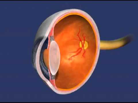 Retinopathy of Prematurity