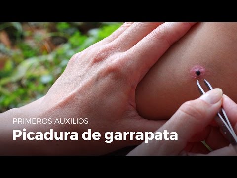, title : 'Primeros auxilios : Picadura de garrapata'