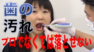 歯の汚れのなかにはプロでなくては落とせないものがある？