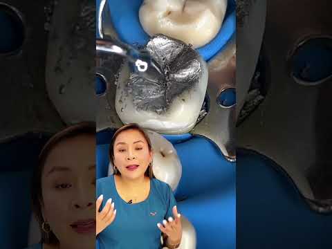 Learn all about amalgams.💪🏻