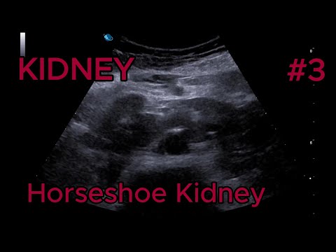 Horseshoe Kidney video preview