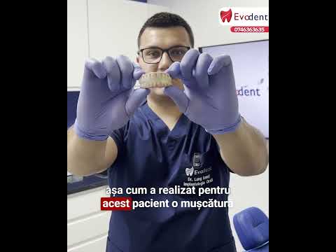 Ce este soluția danturii fixe pe implanturi dentare?