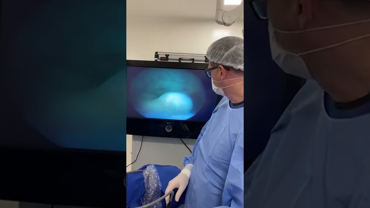 divertículo na bexiga: cistoscopia.