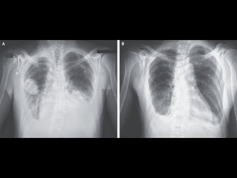 Phantomtumor in der Lunge