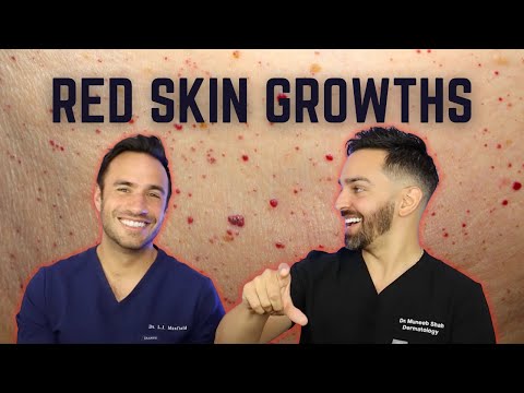 Cherry Angiomas and How to Treat Them | Doctorly Debunked