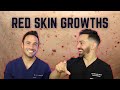 Cherry Angiomas And How To Treat Them Doctorly Debunked
