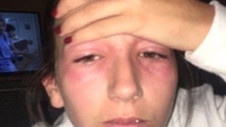 Student who got poison ivy in her EYES becomes an online star after her cruel sister shares photos