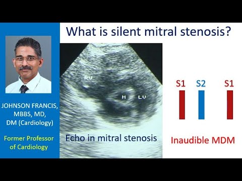What is silent mitral stenosis?