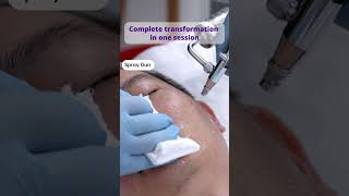 Download lagu Before & After: This Hydro Dermabrasion Facial Delivers a Serious Glow-Up mp3