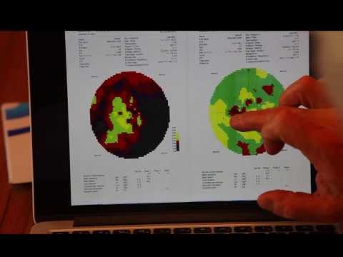 Part 2- STARGARDT'S DISEASE TREATMENT PROOF - Visual field Test