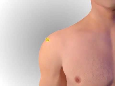 EZ IO® Proximal Humerus Site Animation