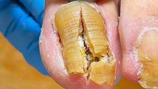Extra Long Toenails Are Rotten And Fermented By Fungi!【Xue Yidao】