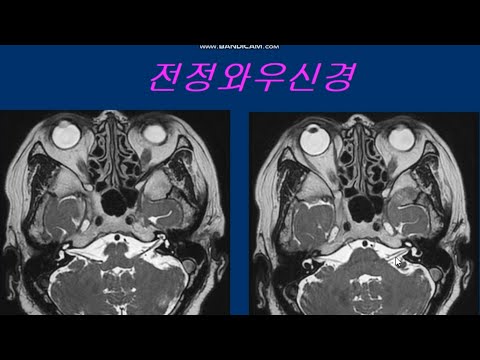 청신경 종양MRI