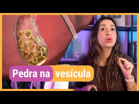 Pedra na vesícula (cálculos biliares) e colecistectomia