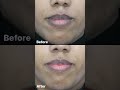 Pink Lips Laser