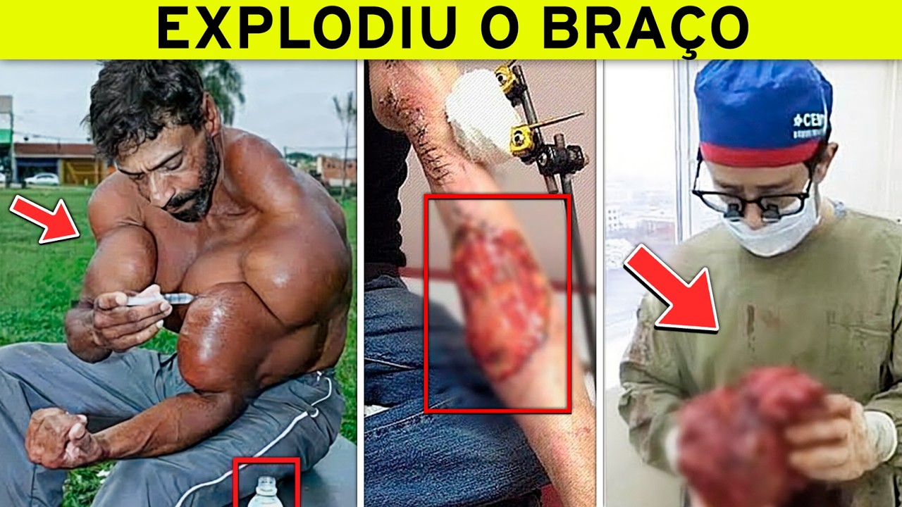 Músculos Falsos Que Deram Muito Errado