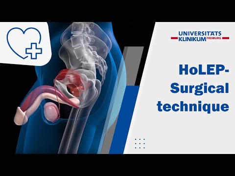 ANIMATION - Holmium Laser Enucleation of the Prostate (HoLEP) – „3 horseshoe technique“