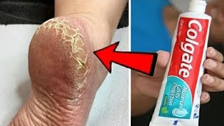 Eliminate Cracked Heels and Get White Smooth Feet / Cracked Heels Home Remedy