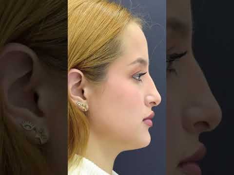 Feminine Nose Refinement in Turkey | Female Rhinoplasty with Dr. Hüseyin Balıkçı