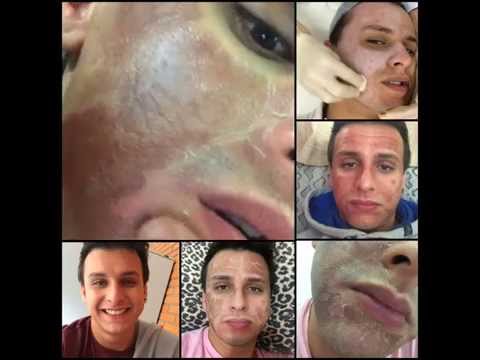 Leliminazione di lentiggini e pigmentary nota in saloni Celebrità con konopushka