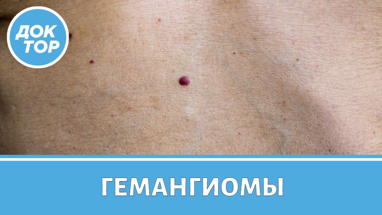 Гемангиомы и другие сосудистые опухоли: когда бить тревогу